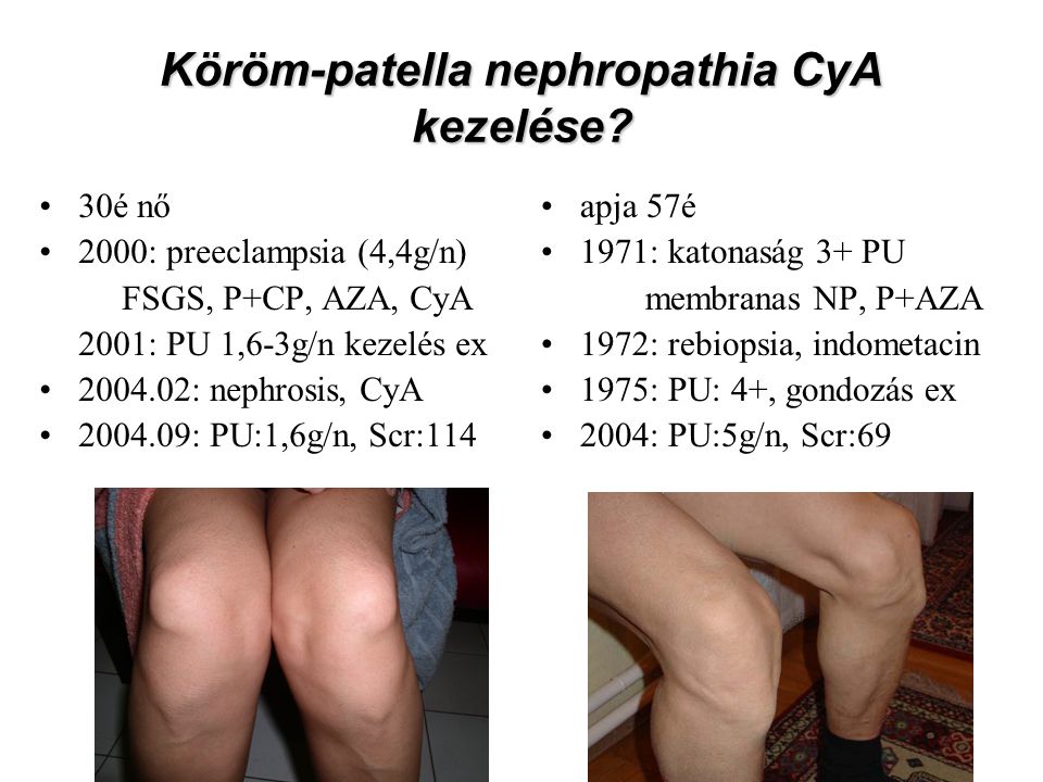 Köröm-patella nephropathia CyA kezelése