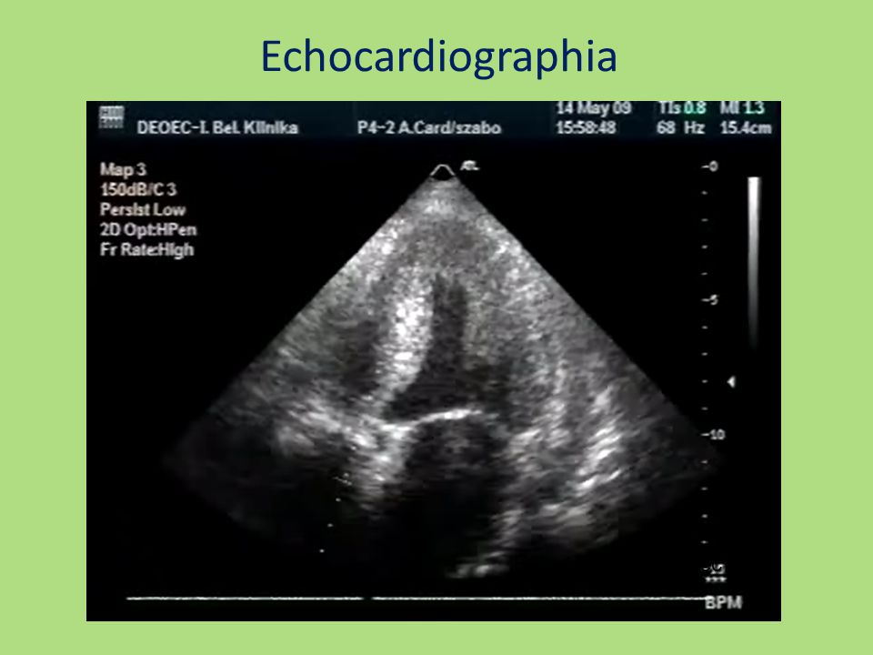 Echocardiographia E/A>1, DT<150 msec