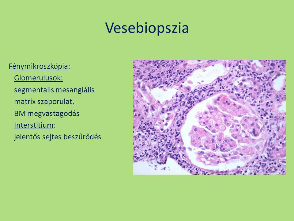 Vesebiopszia Fénymikroszkópia: Glomerulusok: segmentalis mesangiális matrix szaporulat, BM megvastagodás Interstitium: jelentős sejtes beszűrődés
