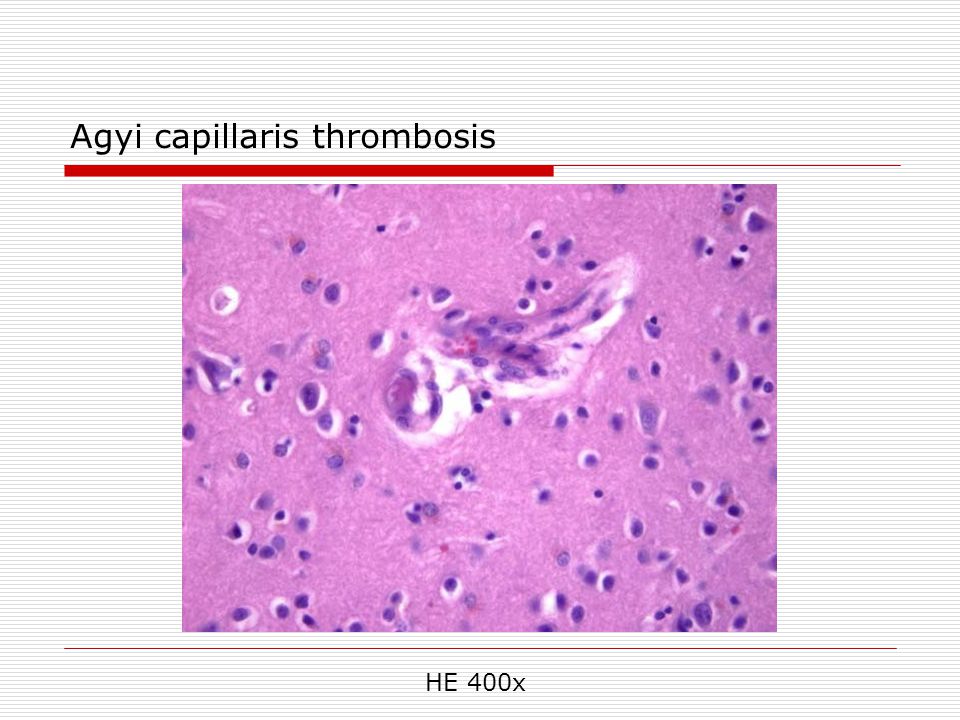 Agyi capillaris thrombosis