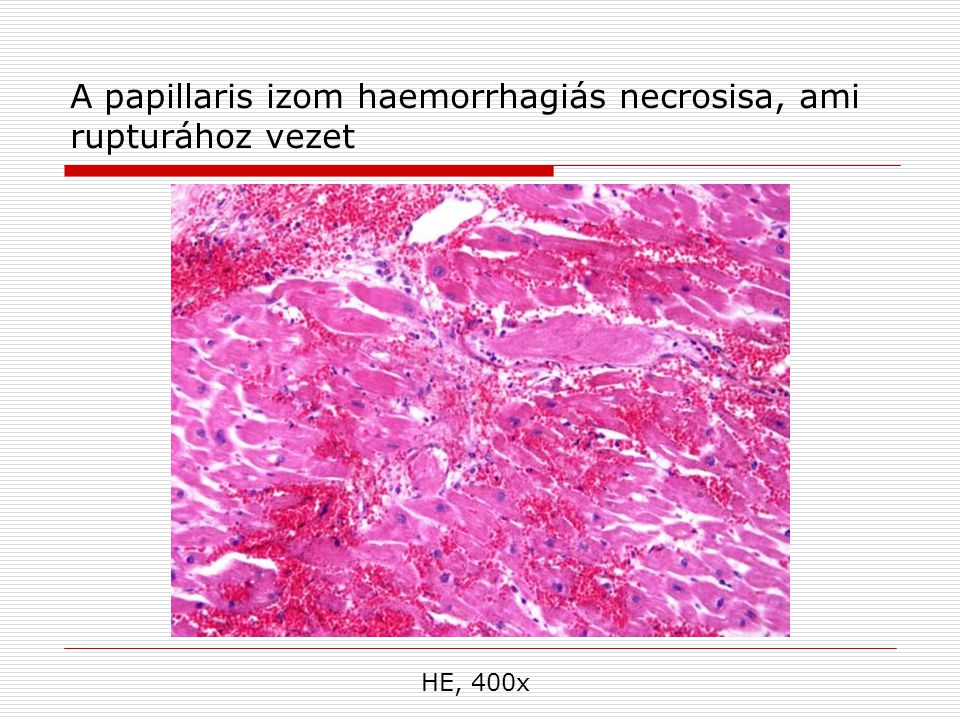 A papillaris izom haemorrhagiás necrosisa, ami rupturához vezet