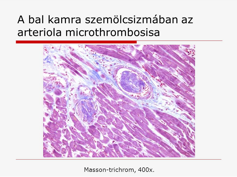 A bal kamra szemölcsizmában az arteriola microthrombosisa