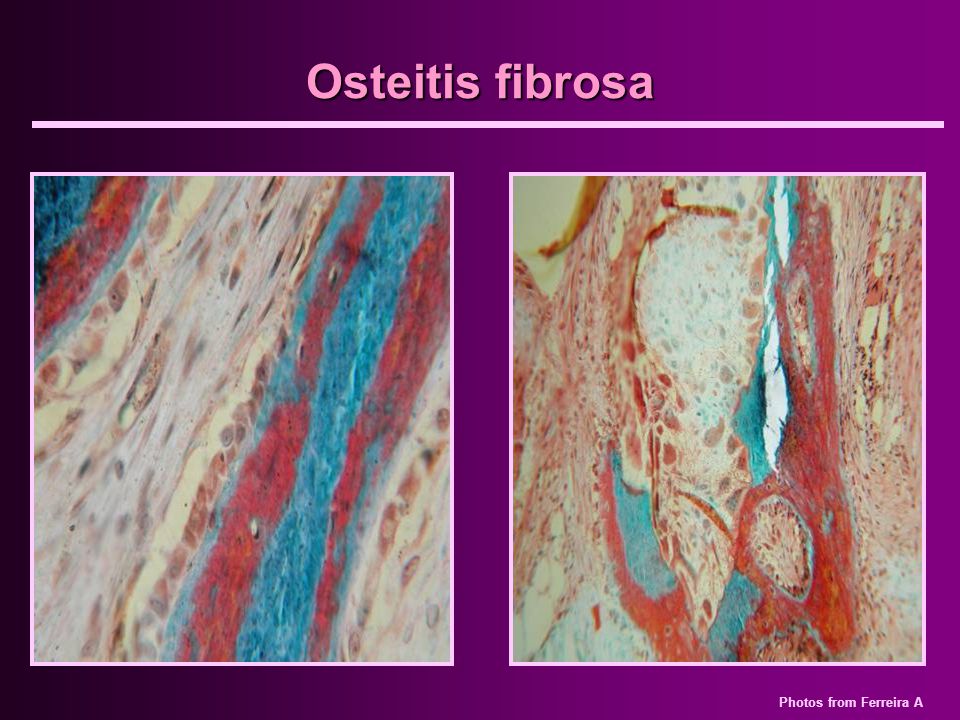 Osteitis fibrosa A korábbiak láthatóak ezen a képen is.