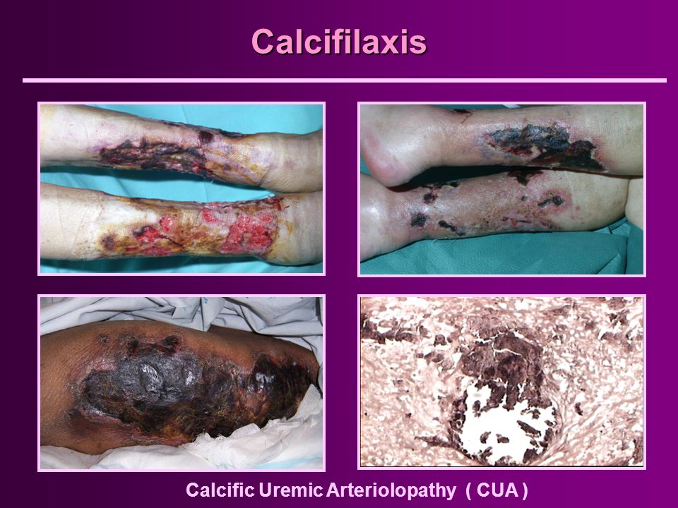 Calcifilaxis Calcific Uremic Arteriolopathy ( CUA )