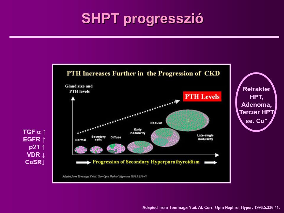 SHPT progresszió Refrakter HPT, Adenoma, Tercier HPT se. Ca↑ TGF α ↑