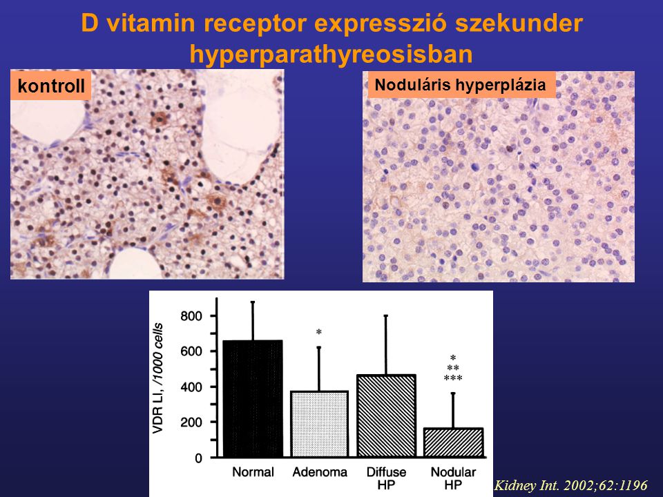 D vitamin receptor expresszió szekunder hyperparathyreosisban