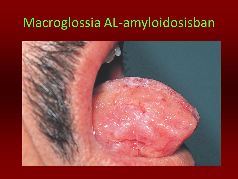 Macroglossia AL-amyloidosisban