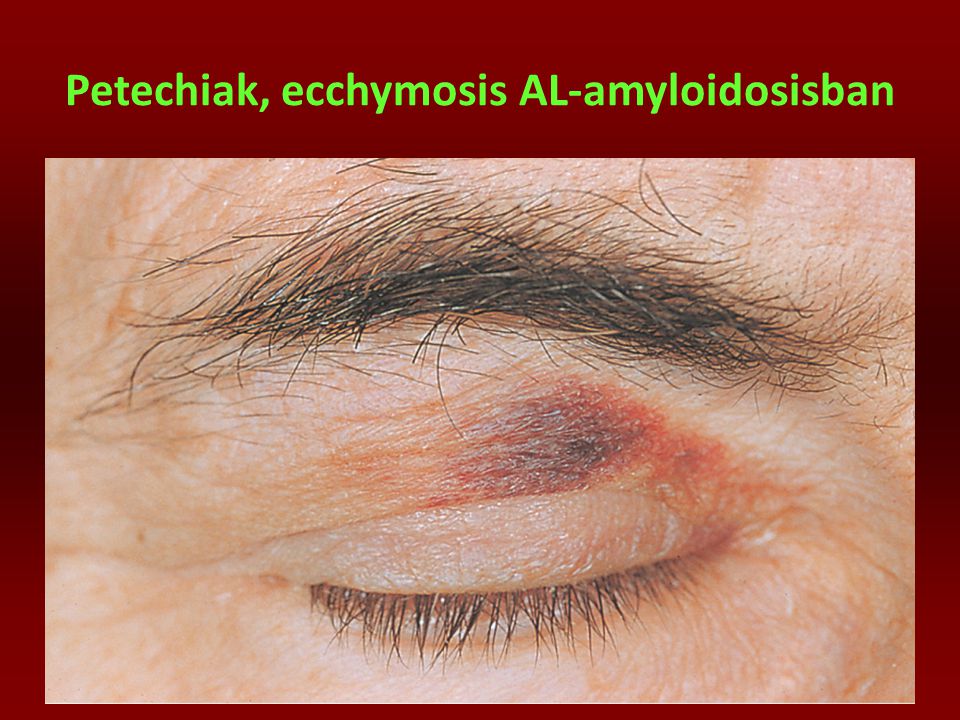 Petechiak, ecchymosis AL-amyloidosisban