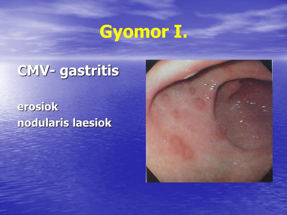 Gyomor I. CMV- gastritis erosiok nodularis laesiok