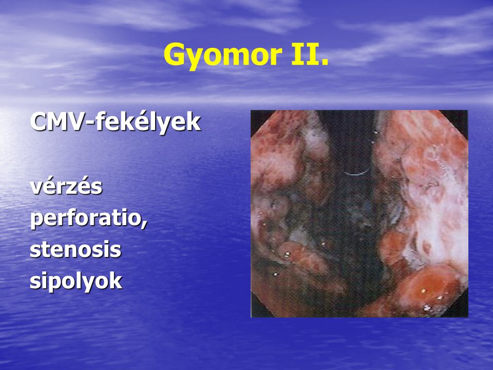 Gyomor II. CMV-fekélyek vérzés perforatio, stenosis sipolyok