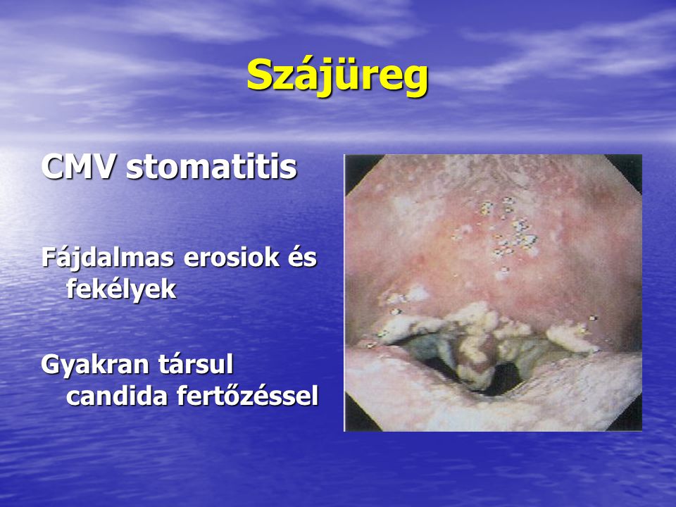 Szájüreg CMV stomatitis Fájdalmas erosiok és fekélyek