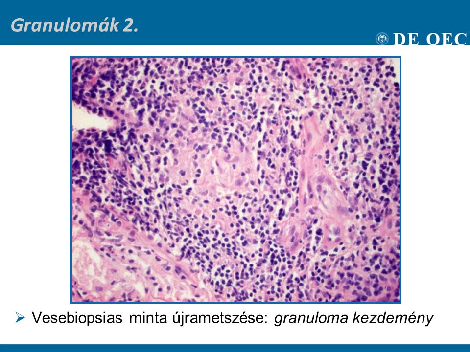Granulomák 2. Vesebiopsias minta újrametszése: granuloma kezdemény