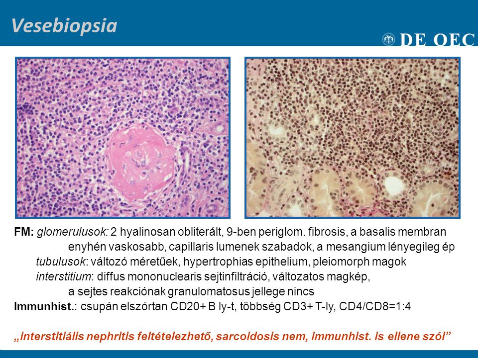 Vesebiopsia FM: glomerulusok: 2 hyalinosan obliterált, 9-ben periglom. fibrosis, a basalis membran.