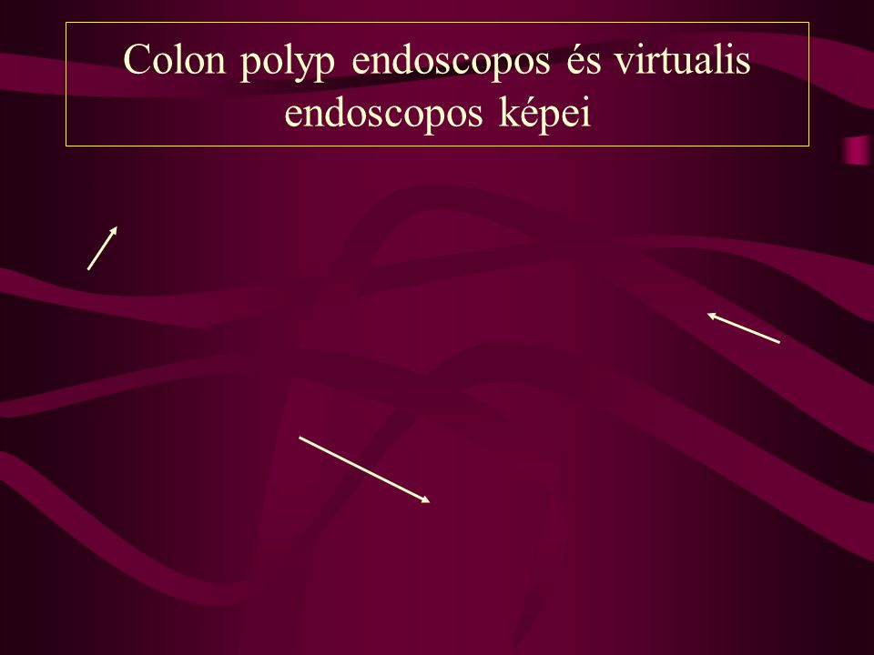 Colon polyp endoscopos és virtualis endoscopos képei