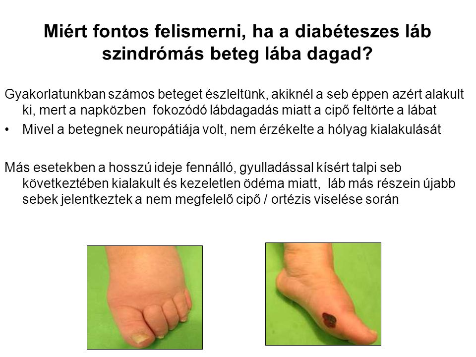 Diabéteszes láb kezelése - Cukorbetegközpont