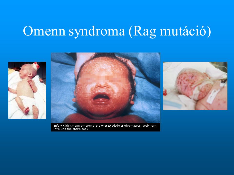 Omenn syndroma (Rag mutáció)