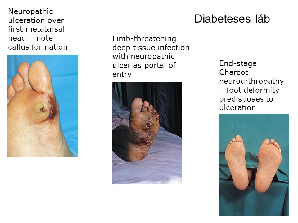foot betegségek cukorbetegség kezelésének