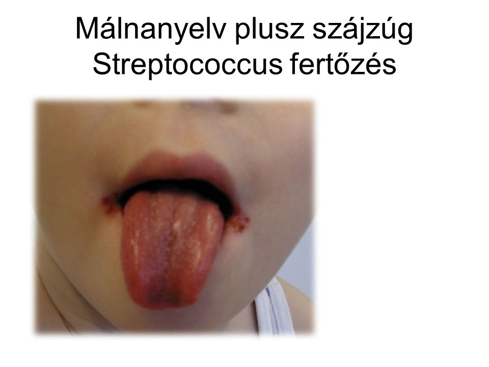Málnanyelv plusz szájzúg Streptococcus fertőzés