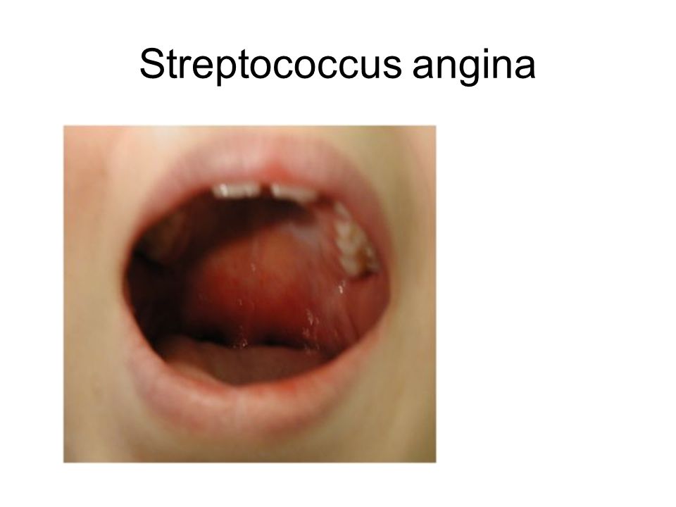 Streptococcus angina