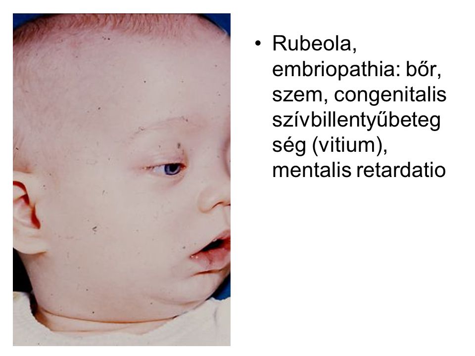Rubeola, embriopathia: bőr, szem, congenitalis szívbillentyűbetegség (vitium), mentalis retardatio