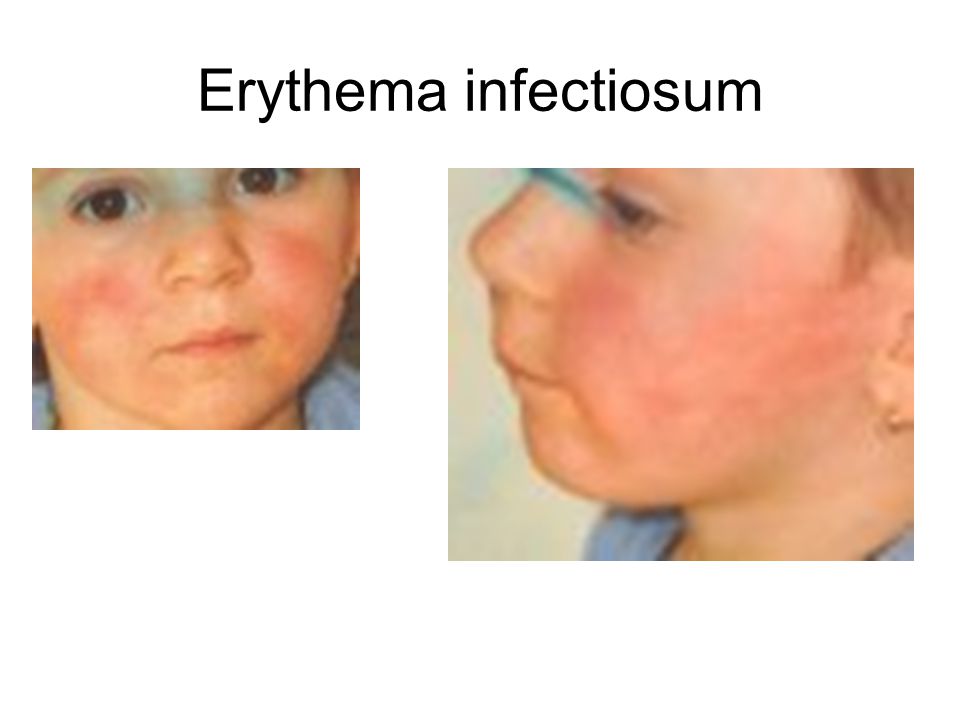 Erythema infectiosum