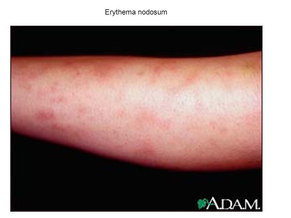 Erythema nodosum