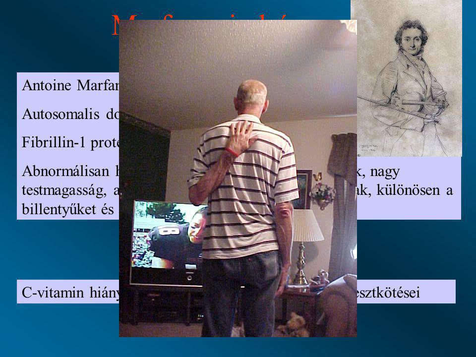 Marfan szindróma Skorbut Antoine Marfan 1899