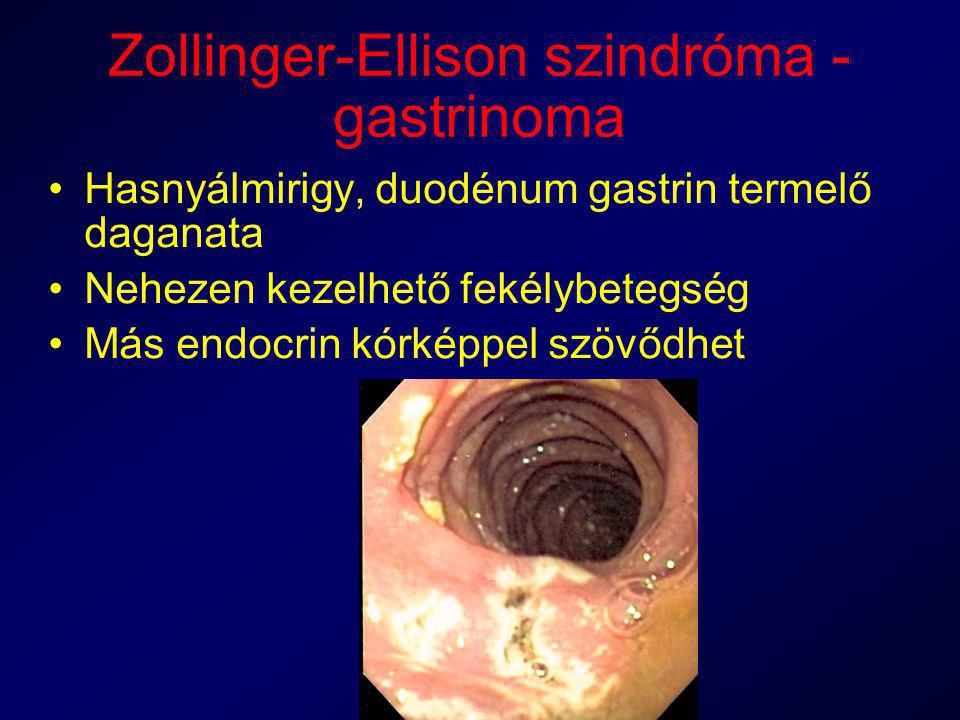 Zollinger-Ellison szindróma - gastrinoma