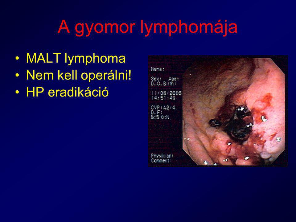 A gyomor lymphomája MALT lymphoma Nem kell operálni! HP eradikáció