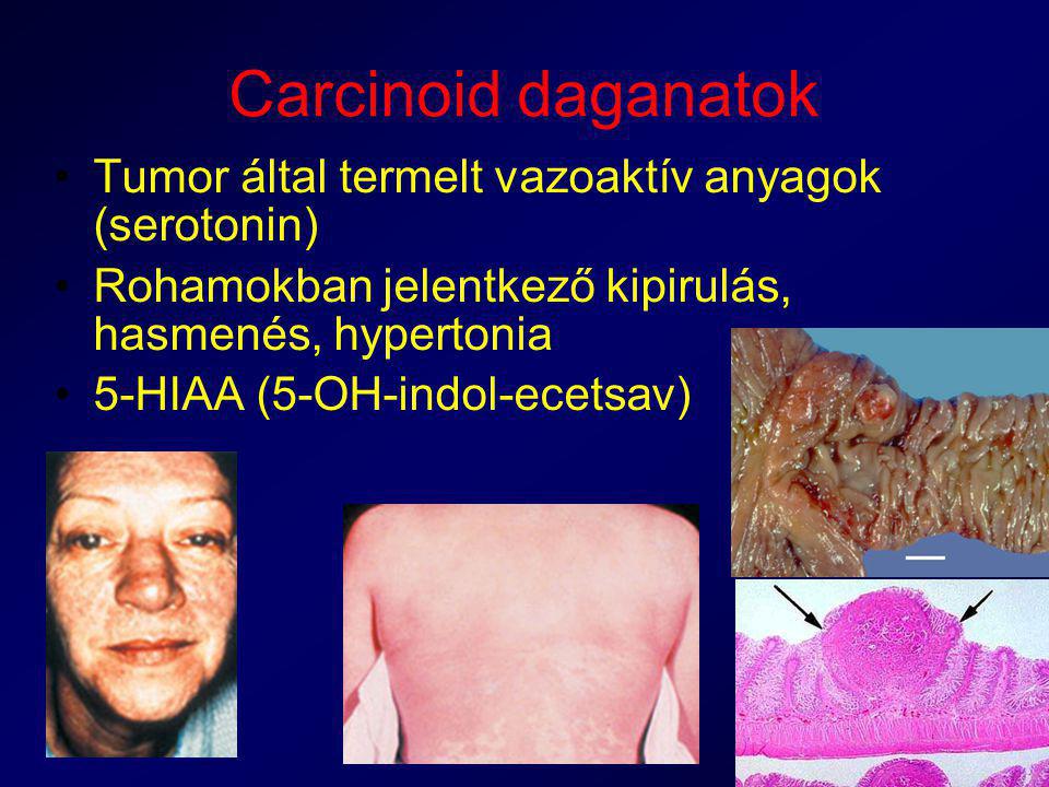Carcinoid daganatok Tumor által termelt vazoaktív anyagok (serotonin)