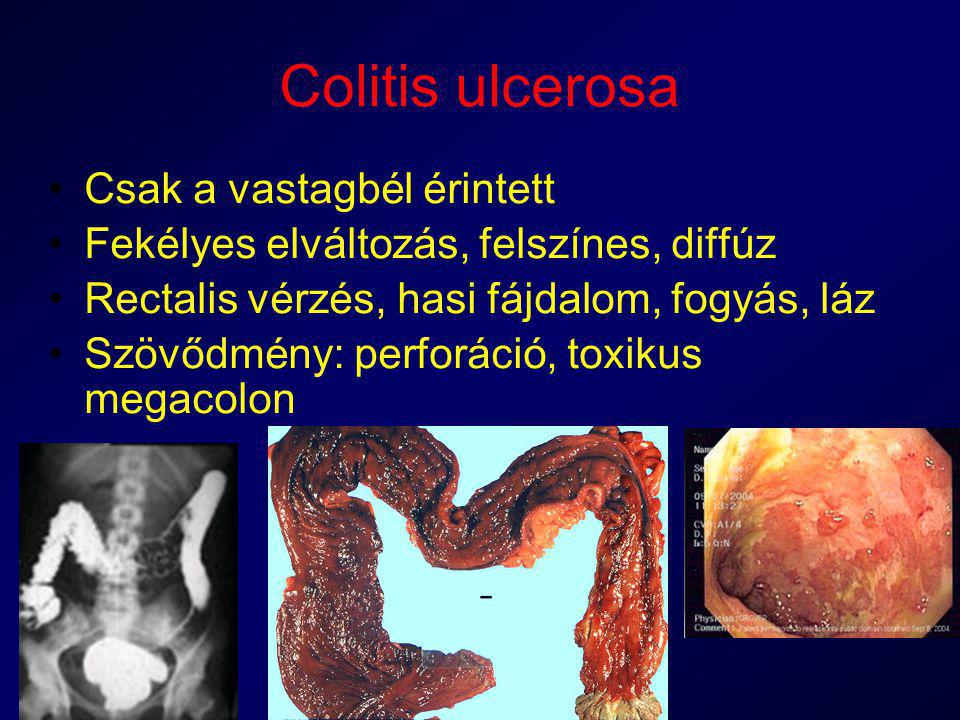Colitis ulcerosa Csak a vastagbél érintett