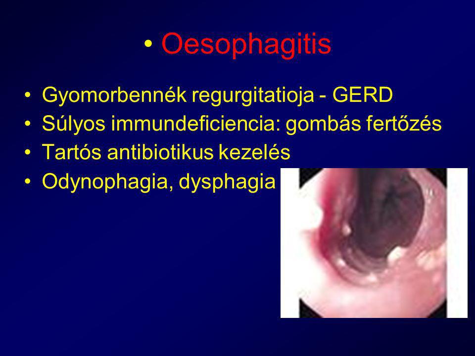 Oesophagitis Gyomorbennék regurgitatioja - GERD