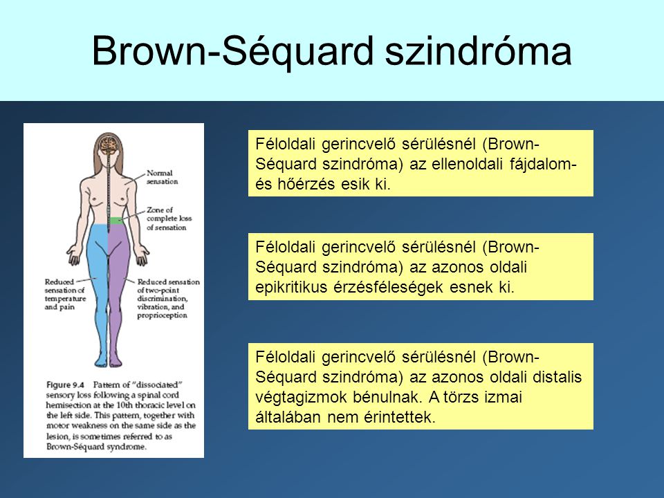 Brown-Séquard szindróma