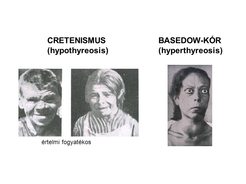 CRETENISMUS (hypothyreosis) BASEDOW-KÓR (hyperthyreosis)