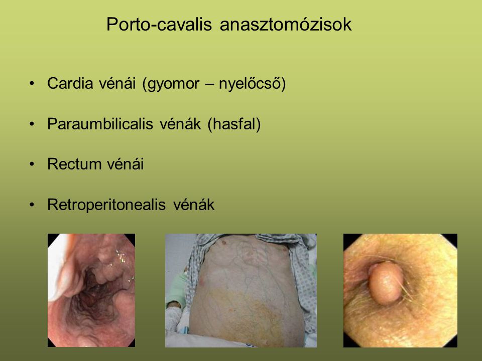 Porto-cavalis anasztomózisok