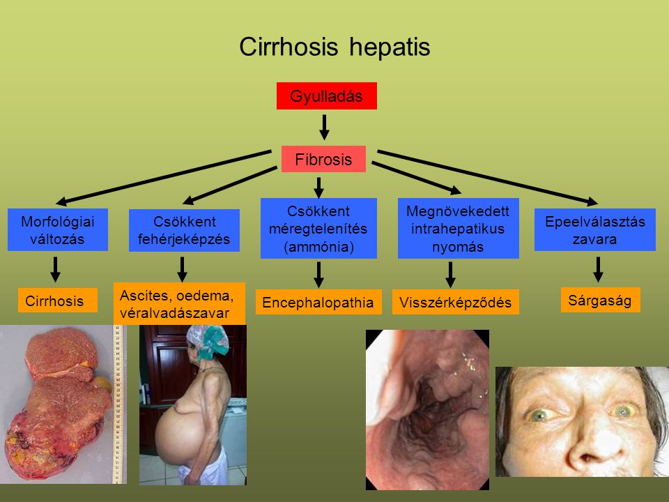 Cirrhosis hepatis Gyulladás Fibrosis fibrosis