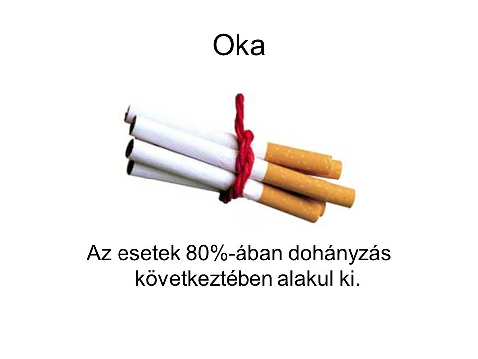Az esetek 80%-ában dohányzás következtében alakul ki.