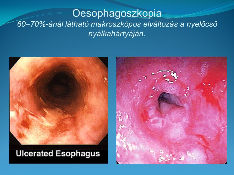 Oesophagoszkopia 60–70%-ánál látható makroszkópos elváltozás a nyelőcső nyálkahártyáján.