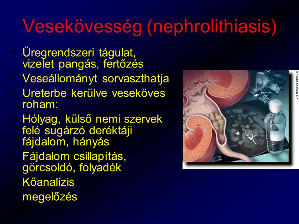 Vesekövesség (nephrolithiasis)