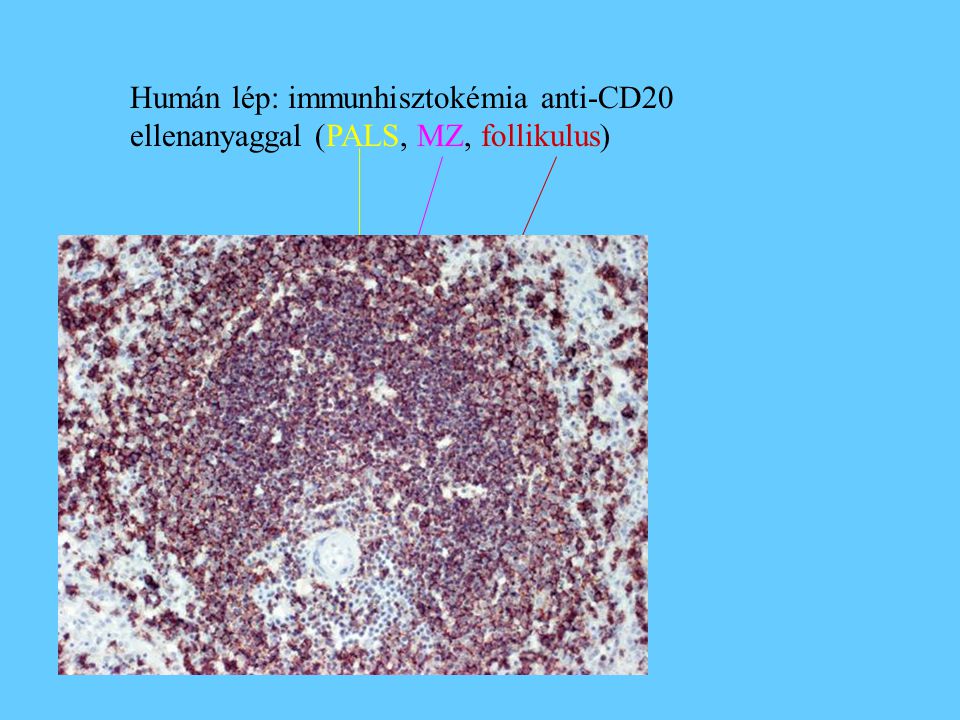 Humán lép: immunhisztokémia anti-CD20 ellenanyaggal (PALS, MZ, follikulus)