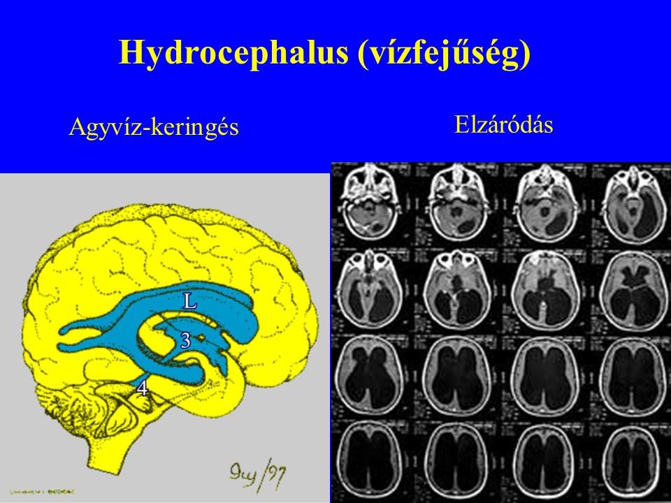 Hydrocephalus (vízfejűség)