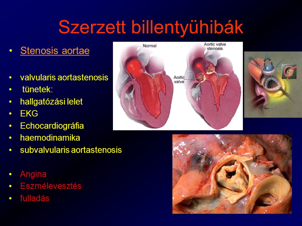fogyás aorta szűkület)