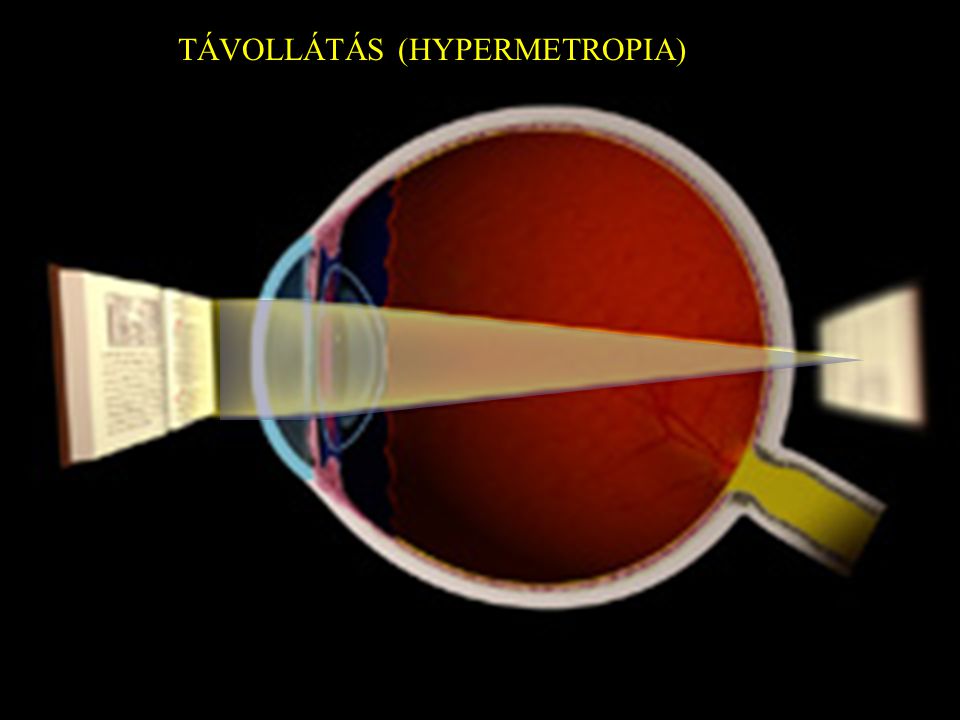 Hyperopia strabismus szemüveg nagyon erős