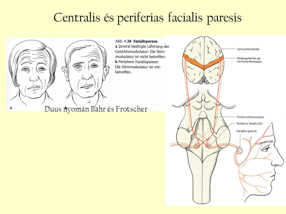 Centralis és periferias facialis paresis