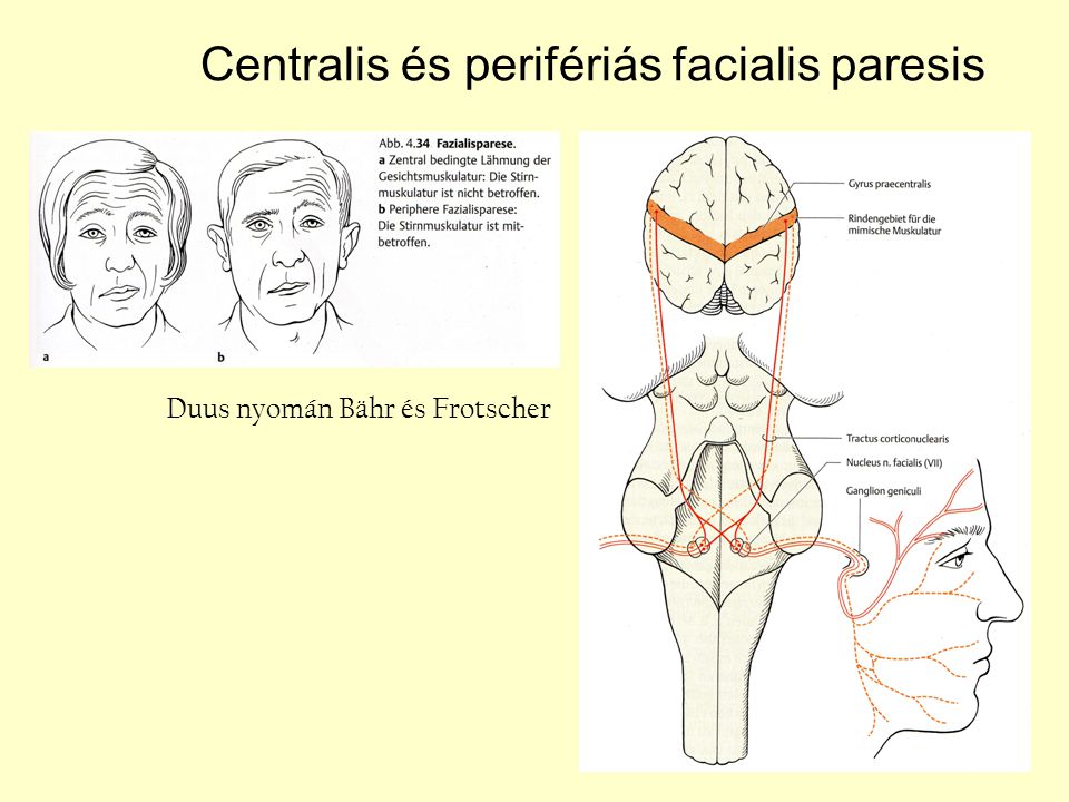 Centralis és perifériás facialis paresis