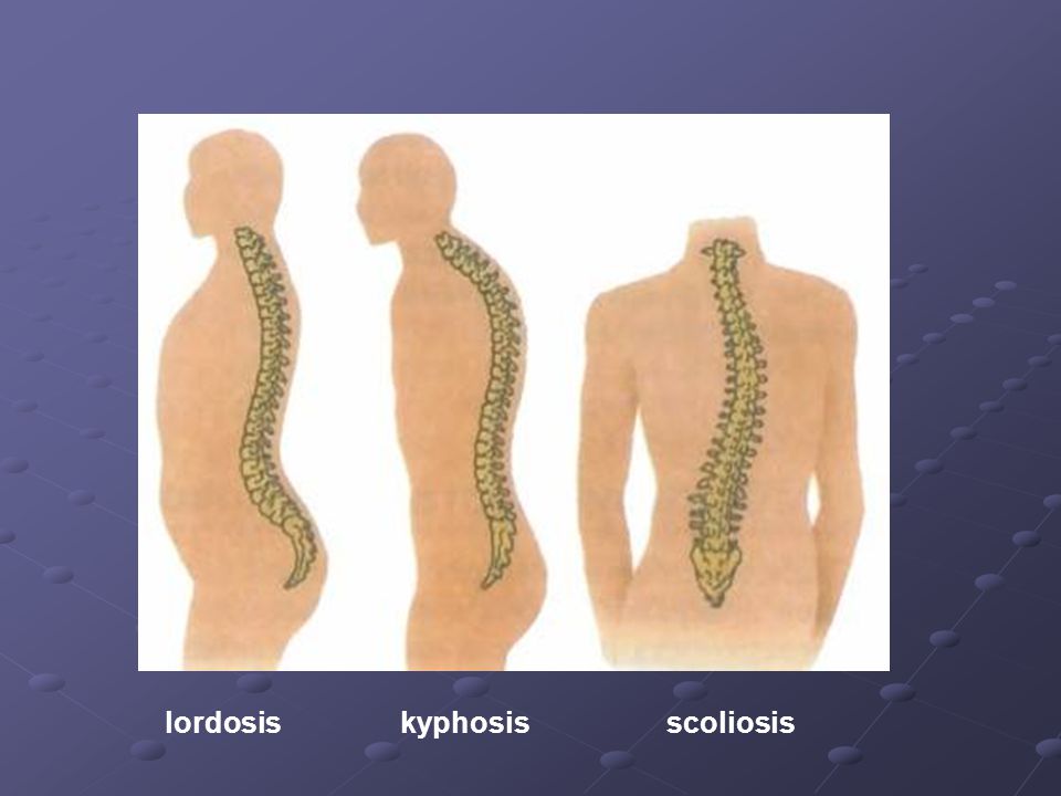 lordosis kyphosis scoliosis