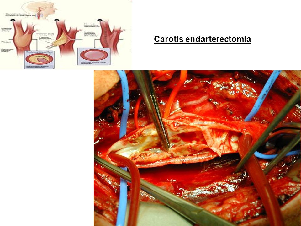 Carotis endarterectomia