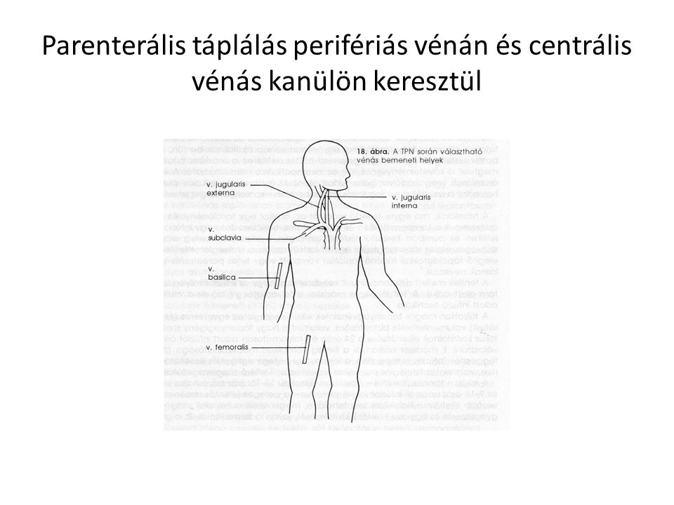 Parenterális táplálás perifériás vénán és centrális vénás kanülön keresztül