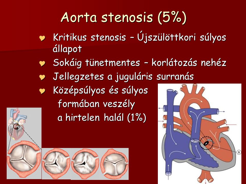 súlycsökkenés és aorta szűkület