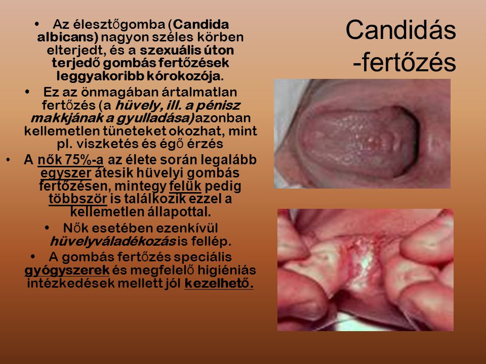 Candida-fertőzés
